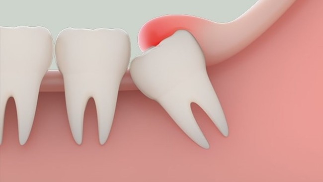 Tìm hiểu về tiểu phẫu nhổ răng khôn: Có đau không? Bao lâu thì lành? - Ảnh 2.