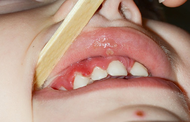 Viêm nướu răng ở trẻ em và những điều cần biết - Ảnh 2.