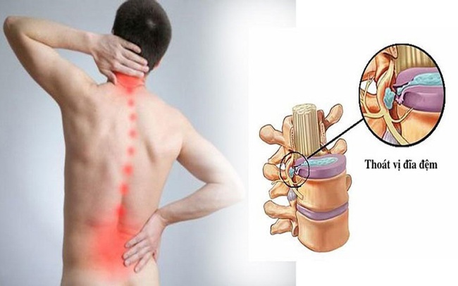 Thoát vị đĩa đệm cột sống thắt lưng: Nguyên nhân, dấu hiệu, các cấp độ và cách điều trị - Ảnh 1.