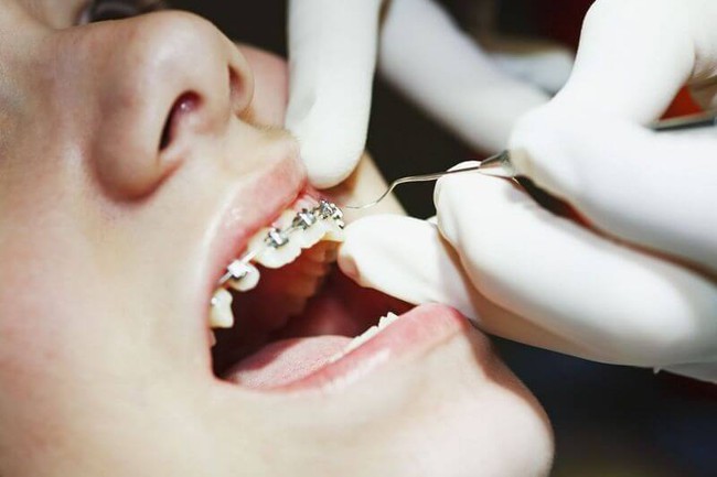 Tìm hiểu 4 bước trong quy trình niềng răng? - Ảnh 2.