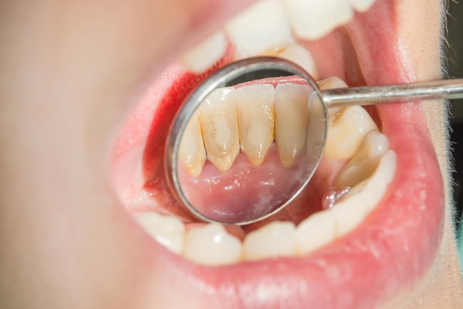6 cách lấy cao răng tại nhà một cách tự nhiên và an toàn - Ảnh 5.