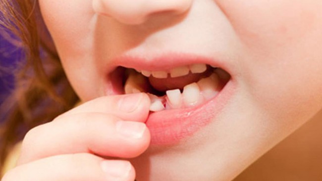 Những răng nào sẽ thay ở trẻ em? Răng sữa không thay có sao không? - Ảnh 1.
