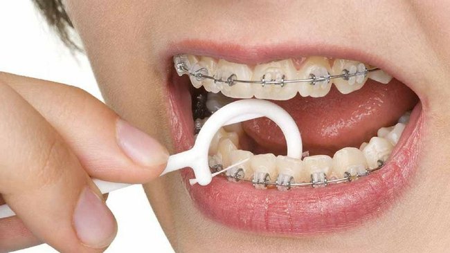 Những tác hại của niềng răng mà bạn có thể chưa bao giờ được biết - Ảnh 2.