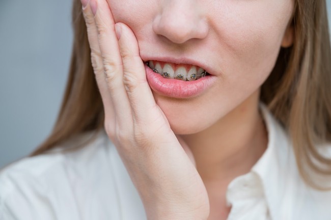 Những tác hại của niềng răng mà bạn có thể chưa bao giờ được biết - Ảnh 3.