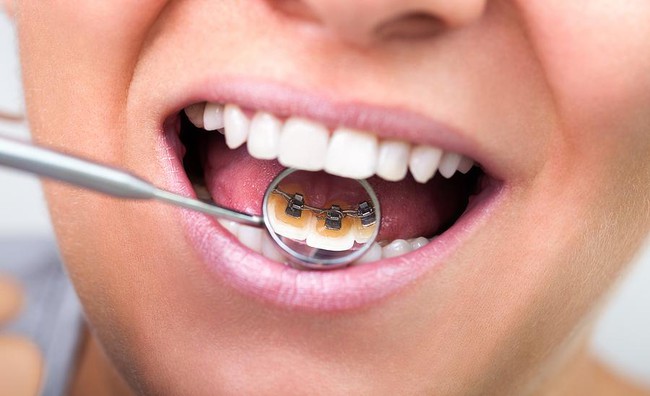 Những tác hại của niềng răng mà bạn có thể chưa bao giờ được biết - Ảnh 4.