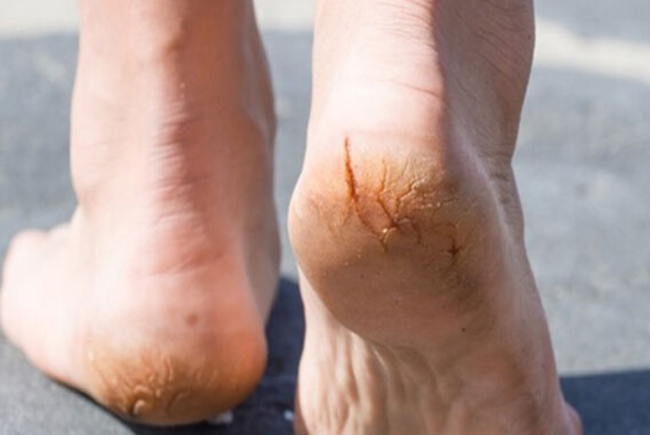 Gót chân bị tróc da là bệnh gì? Làm thế nào để cải thiện? - Ảnh 4.