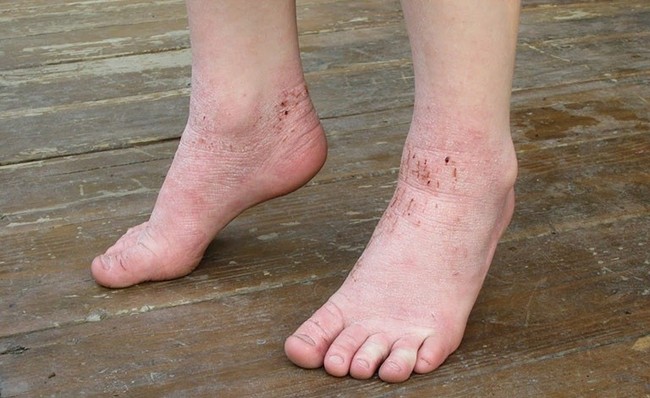 Gót chân bị tróc da là bệnh gì? Làm thế nào để cải thiện? - Ảnh 3.