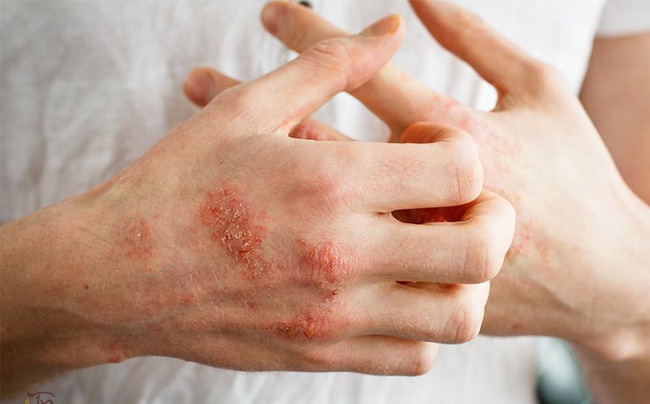 'Detox' da tại spa, cô gái bị bội nhiễm da Eczema herpeticum - Ảnh 3.