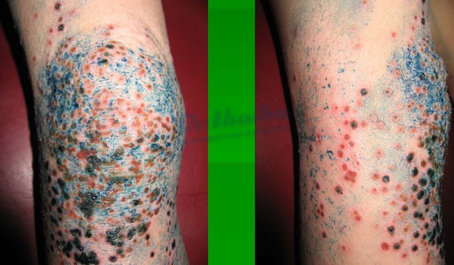 'Detox' da tại spa, cô gái bị bội nhiễm da Eczema herpeticum - Ảnh 2.
