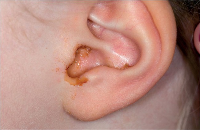 Cách phòng tránh viêm tai giữa cho trẻ vào mùa thu đông - Ảnh 3.