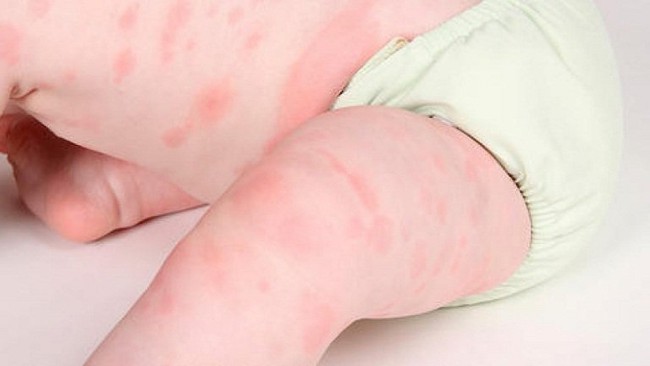 Những vấn đề về da ở trẻ thường gặp vào mùa đông - Ảnh 3.
