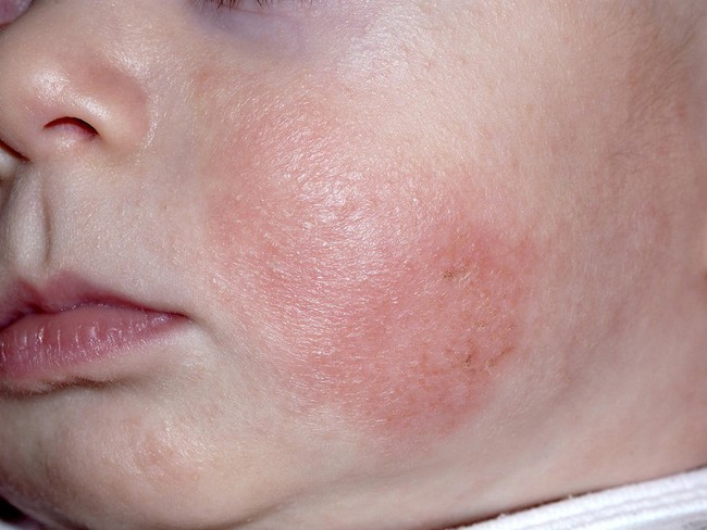 Những vấn đề về da ở trẻ thường gặp vào mùa đông - Ảnh 2.