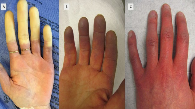 Tìm hiểu về hội chứng Raynaud khiến tay bị tím tái, đau buốt vào mùa đông - Ảnh 2.