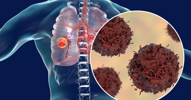 Bệnh ung thư phổi có chữa được không? Các phương pháp điều trị ung thư phổi hiện nay - Ảnh 1.