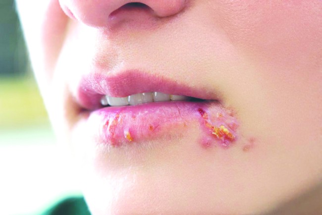 Hướng dẫn cách chữa rộp môi (Herpes môi) nhanh nhất tại nhà - Ảnh 1.