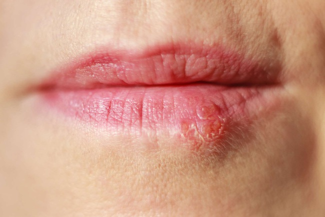 Hướng dẫn cách chữa rộp môi (Herpes môi) nhanh nhất tại nhà - Ảnh 3.