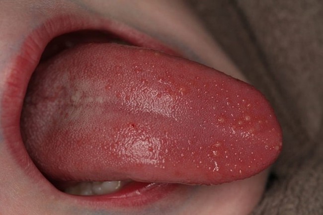 Lưỡi nổi hạt không đau là bệnh gì?  - Ảnh 1.