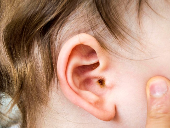 Viêm tai giữa ở trẻ khi nào cần nhập viện? - Ảnh 2.