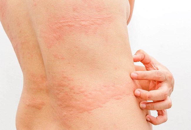 Lưng bị nổi mẩn đỏ ngứa là bệnh gì? Nguyên nhân và cách xử lý - Ảnh 2.