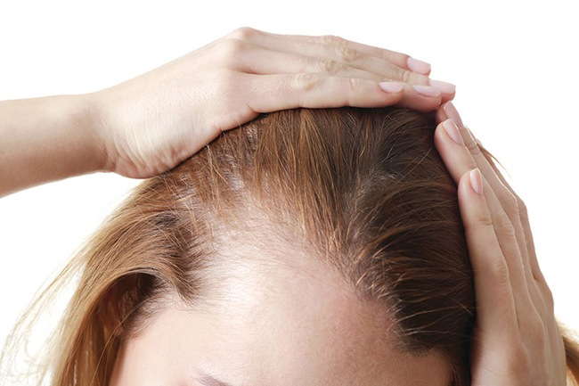 Cách trị ngứa da đầu và rụng tóc an toàn hiệu quả  - Ảnh 3.