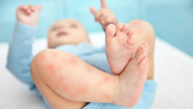 Lang ben ở trẻ sơ sinh là gì? Từ A đến Z về bệnh lang ben ở trẻ sơ sinh - Ảnh 3.
