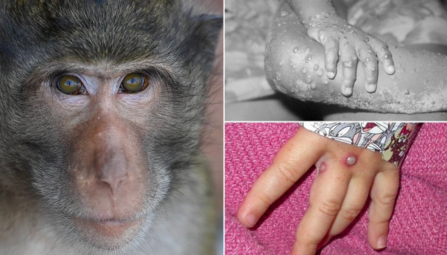 Bộ Y tế: 6 biện pháp phòng chống đậu mùa khỉ khi dịch có xu hướng gia tăng - Ảnh 1.
