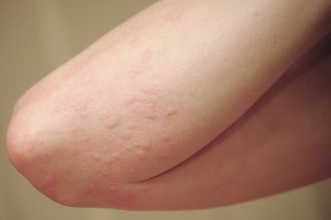 Da bị nổi mẩn đỏ ngứa như muỗi đốt là bệnh gì? Nguyên nhân và cách điều trị - Ảnh 1.