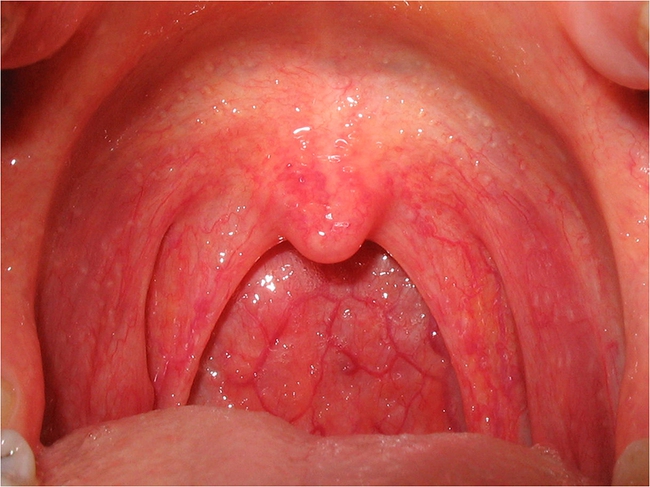 Hiện tượng nuốt nước bọt thấy vướng ở cổ họng là dấu hiệu mắc bệnh gì? - Ảnh 2.