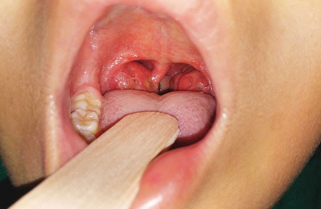 Hiện tượng nuốt nước bọt thấy vướng ở cổ họng là dấu hiệu mắc bệnh gì? - Ảnh 3.