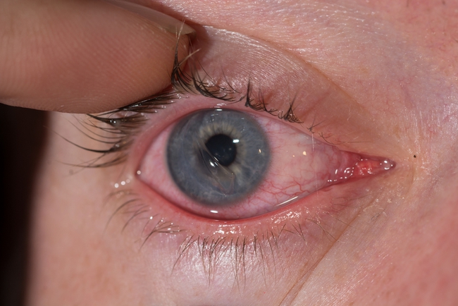 10 nguyên nhân gây đỏ mắt và cách điều trị - Ảnh 4.