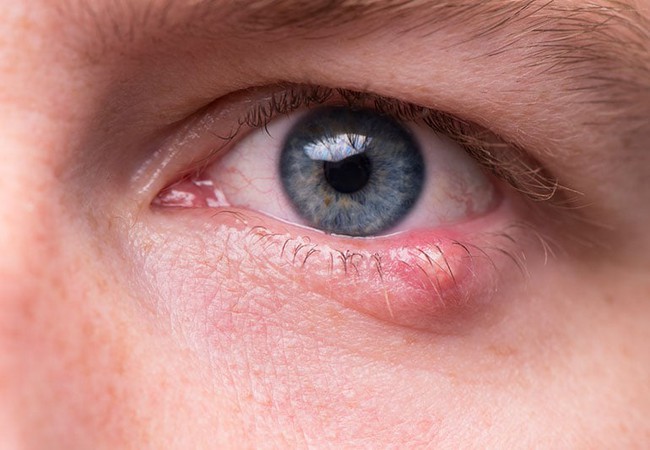 10 nguyên nhân gây đỏ mắt và cách điều trị - Ảnh 7.
