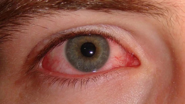 10 nguyên nhân gây đỏ mắt và cách điều trị - Ảnh 2.