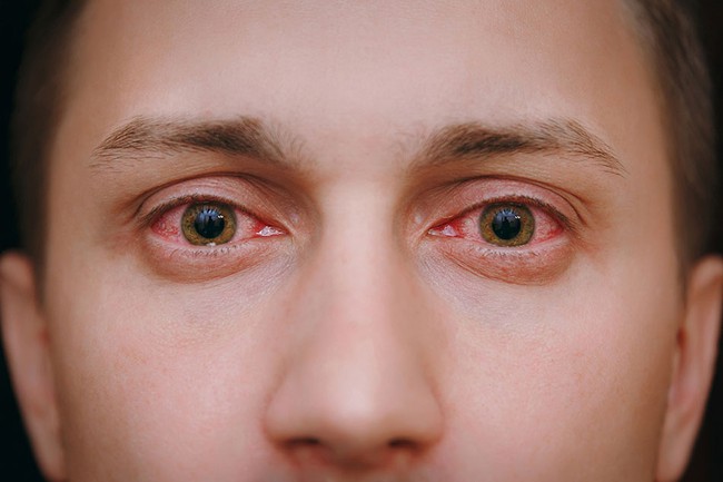 10 nguyên nhân gây đỏ mắt và cách điều trị - Ảnh 6.