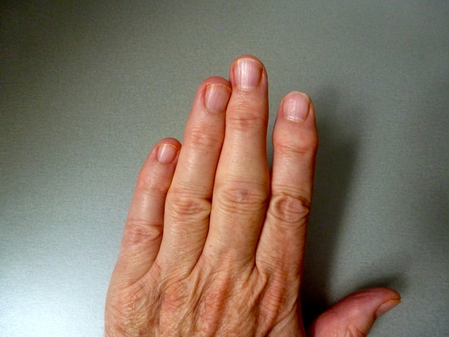 Khớp ngón tay bị sưng đau không chỉ do viêm khớp - Ảnh 3.