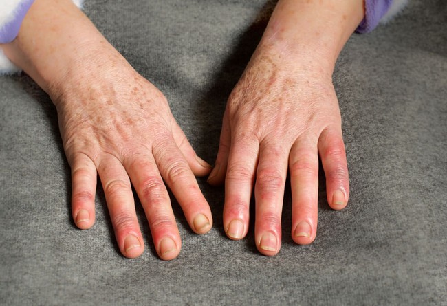 Khớp ngón tay bị sưng đau không chỉ do viêm khớp - Ảnh 4.