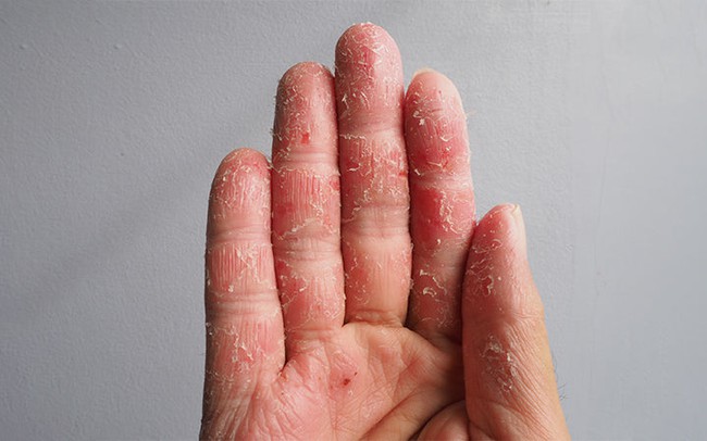 Bong tróc da đầu ngón tay: Nguyên nhân, cách điều trị và phòng ngừa - Ảnh 3.