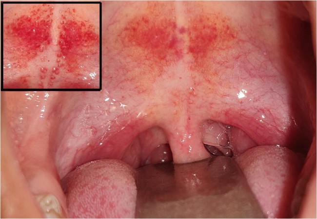 Đốm đỏ trên vòm miệng là do đâu? Nguyên nhân và cách điều trị - Ảnh 3.