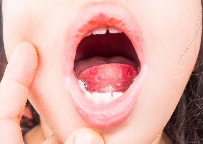 Đốm đỏ trên vòm miệng là do đâu? Nguyên nhân và cách điều trị - Ảnh 5.