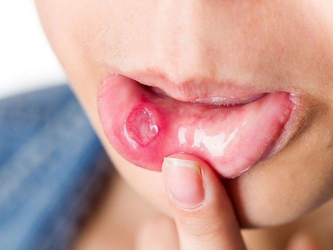 Đốm đỏ trên vòm miệng là do đâu? Nguyên nhân và cách điều trị - Ảnh 6.