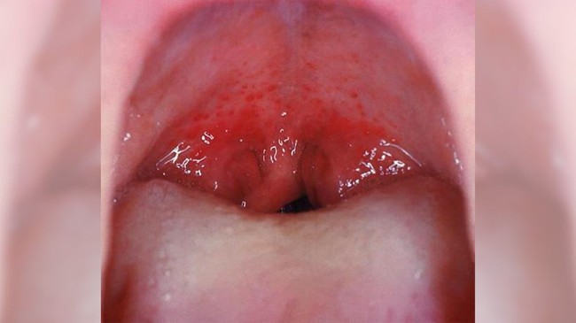 Đốm đỏ trên vòm miệng là do đâu? Nguyên nhân và cách điều trị - Ảnh 2.