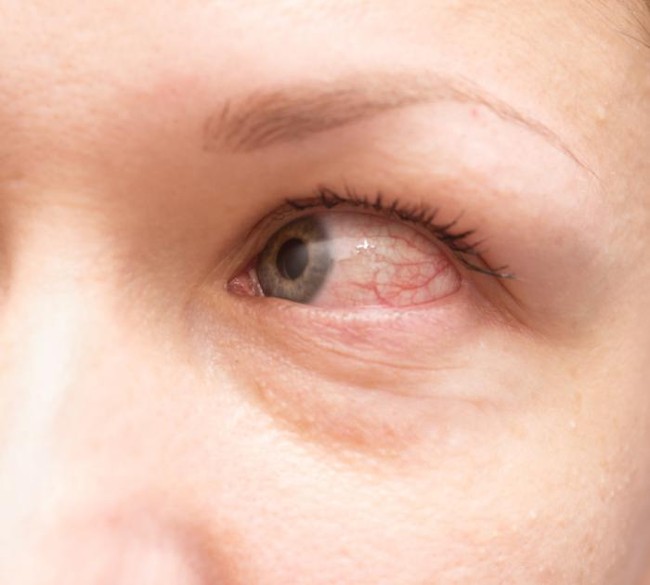 Các loại dị ứng mắt và triệu chứng để phân biệt chính xác nhất - Ảnh 2.