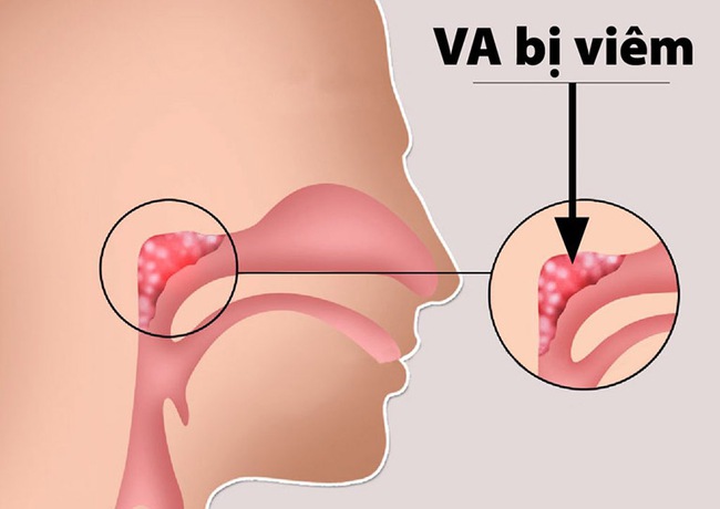 Triệu chứng chuyển nặng của viêm VA là gì? - Ảnh 1.