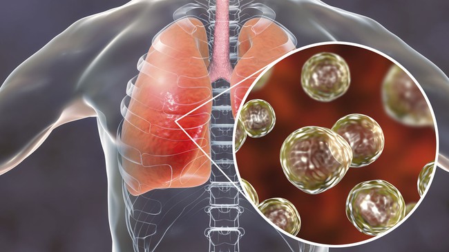 Các loại nấm gây viêm phổi và cách phòng ngừa - Ảnh 2.