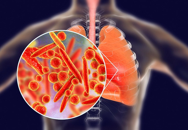 Các loại nấm gây viêm phổi và cách phòng ngừa - Ảnh 1.