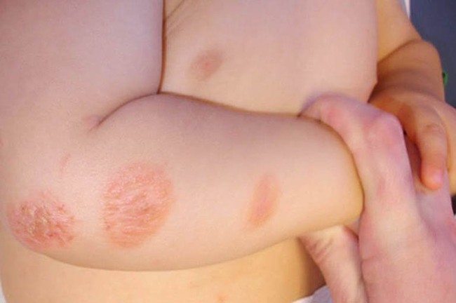 10 tình trạng gây phát ban và sẩn ngứa da mùa hè ở trẻ - Ảnh 9.