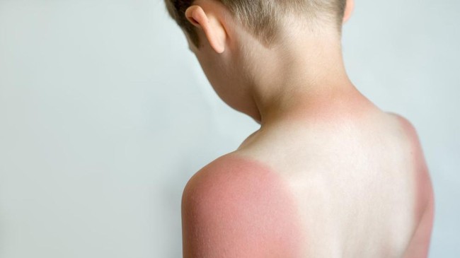 10 tình trạng gây phát ban và sẩn ngứa da mùa hè ở trẻ - Ảnh 12.