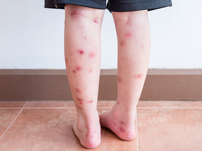 10 tình trạng gây phát ban và sẩn ngứa da mùa hè ở trẻ - Ảnh 4.