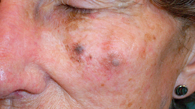 Cẩn thận với những điểm bất thường trên gương mặt có thể là dấu hiệu ung thư da - Ảnh 6.