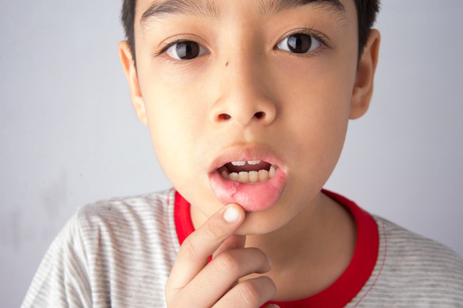 Chuyên gia chia sẻ cách chăm sóc cho trẻ khi bị nhiệt miệng - Ảnh 3.