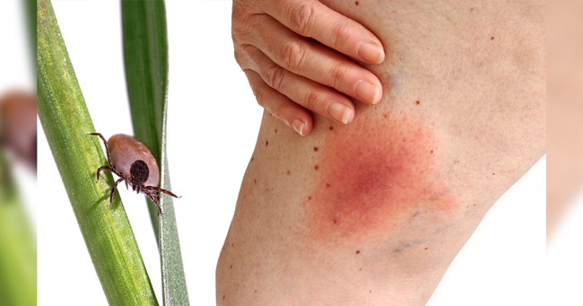 10 bệnh lý lây truyền từ bọ ve mà mọi người cần cẩn trọng - Ảnh 4.